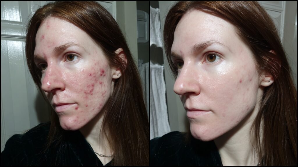 Before and after comparison highlighting the dramatic skin improvements from a looksmaxxing skincare routine with tretinoin for clear skin, illustrating the best skincare routine for looksmaxxing and how to get glowing skin fast.
