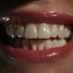 A close-up of a smile with porcelain veneers highlighting teethmaxxing whitening and smile optimization