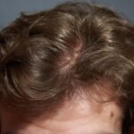 Non-surgical hair loss solutions including hair fibers, hair transplant cost and procedure, and scalp care tips in a hairmaxxing guide.