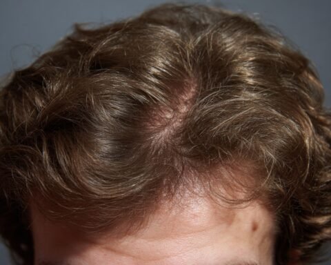 Non-surgical hair loss solutions including hair fibers, hair transplant cost and procedure, and scalp care tips in a hairmaxxing guide.